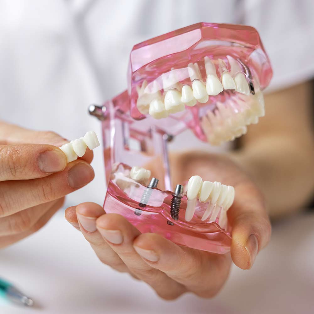 Implant dentaire et bridge : démonstration sur modèle Démonstration d'un bridge sur implants dentaires avec un modèle de mâchoire transparente et couronnes blanches.